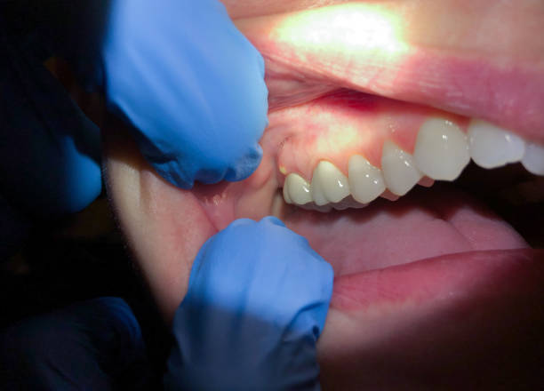 Best Emergency Root Canal Treatment in Sylvester, GA